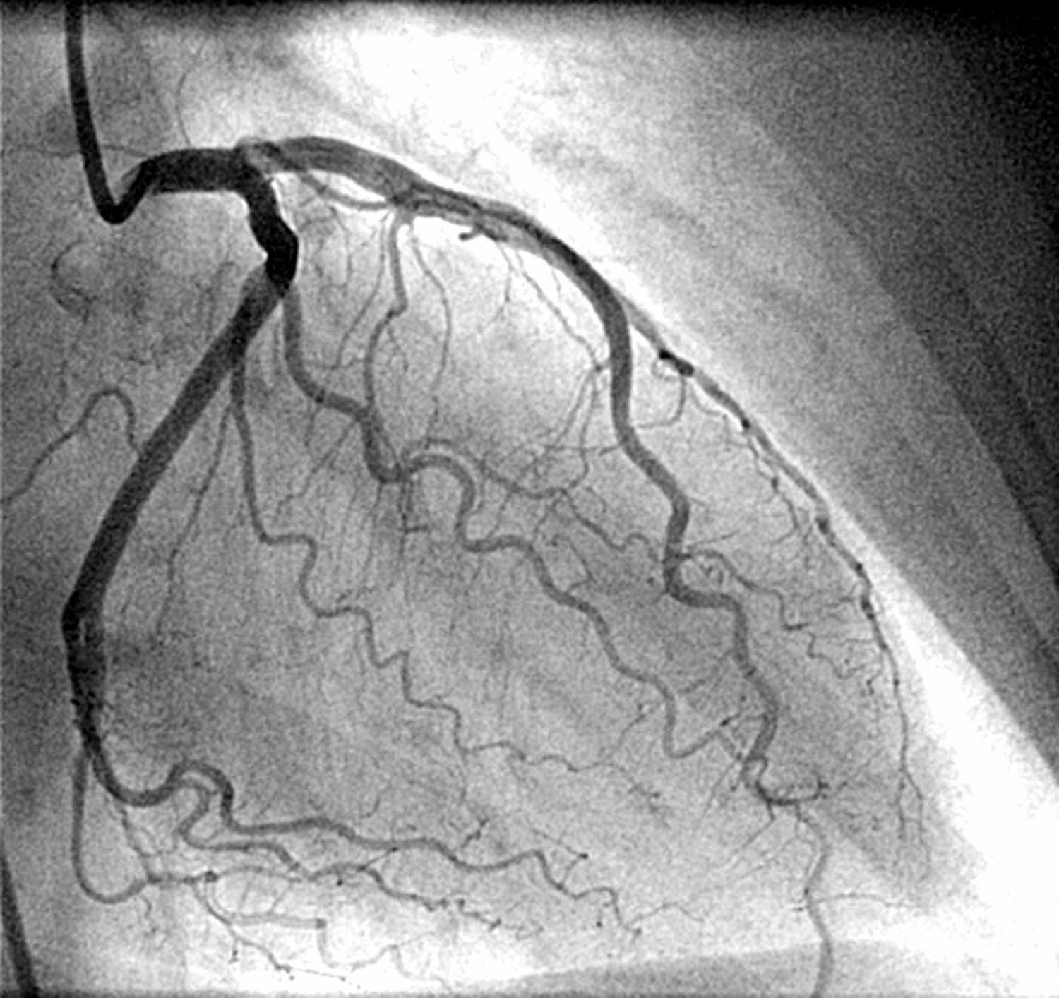Statins Archives - Renal Fellow Network