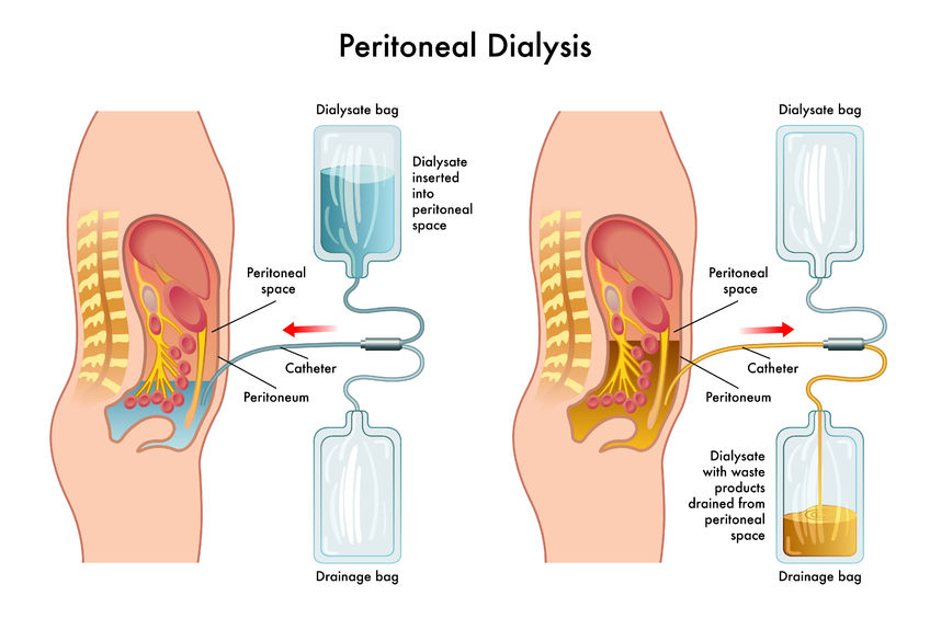 peritoneal-dialysis