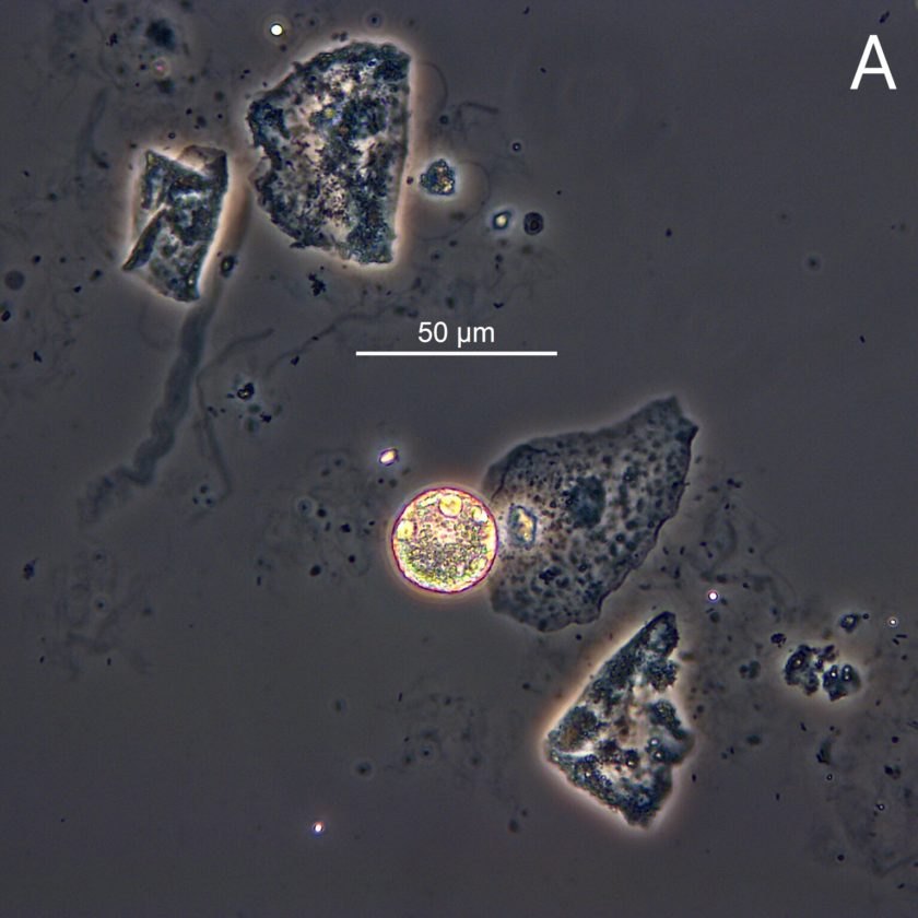 Urine Sediment of the Month Fat Oval Bodies Renal Fellow Network