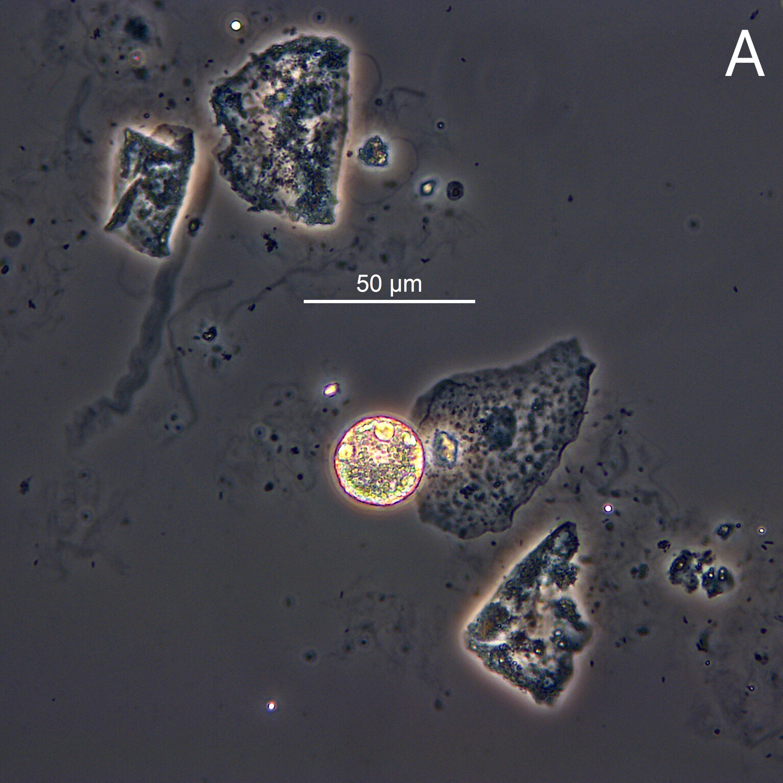 Urine Sediment of the Month Fat Oval Bodies Renal Fellow Network