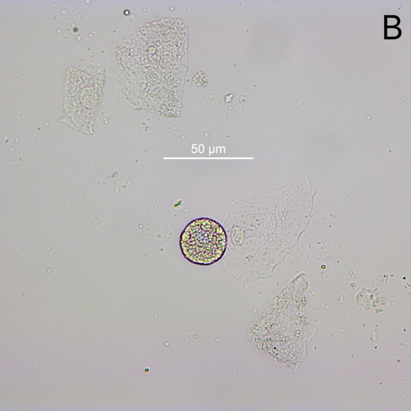 Urine Sediment of the Month Fat Oval Bodies Renal Fellow Network