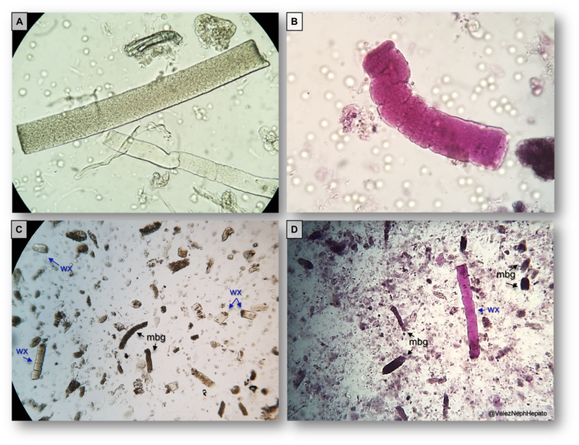 Urine Sediment Of The Month Waxy Casts Renal Fellow Network Urine Sediment Of The Month Waxy Casts Renal Fellow Network
