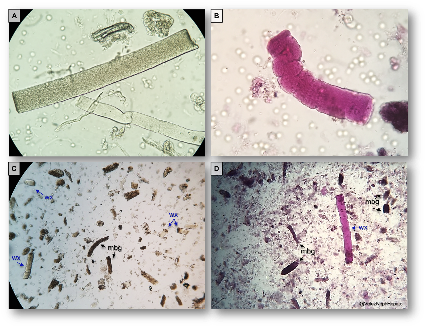 Hyaline Casts In Urine / Microscopic Analysis of Urine | Faculty of Medicine ... - The presence of casts in the urine as a result, not only the amount of urinary casts but also their type is indicated in the urine test.
