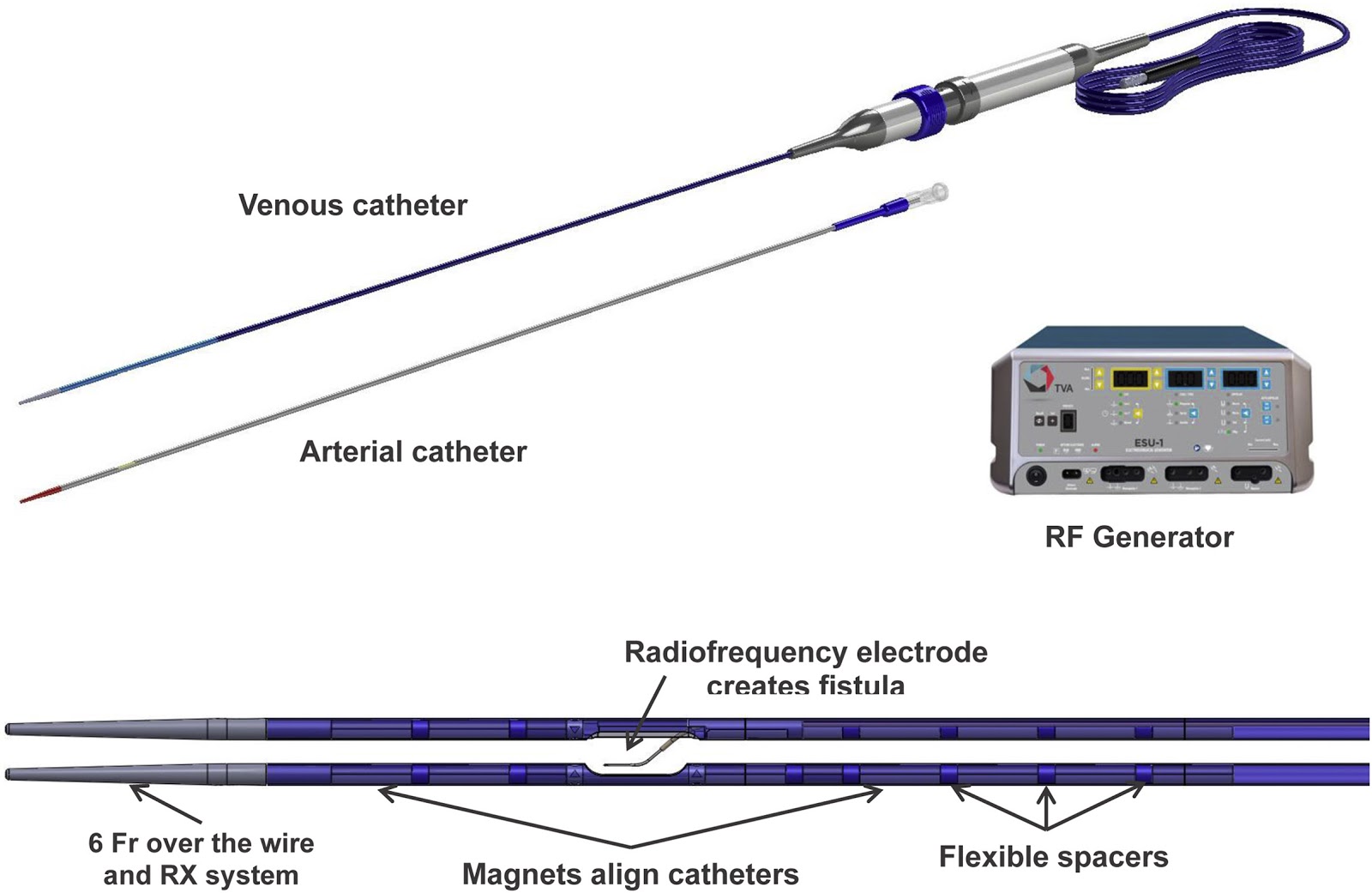 Endovascular Technique for Arteriovenous Fistula Creation - Renal ...