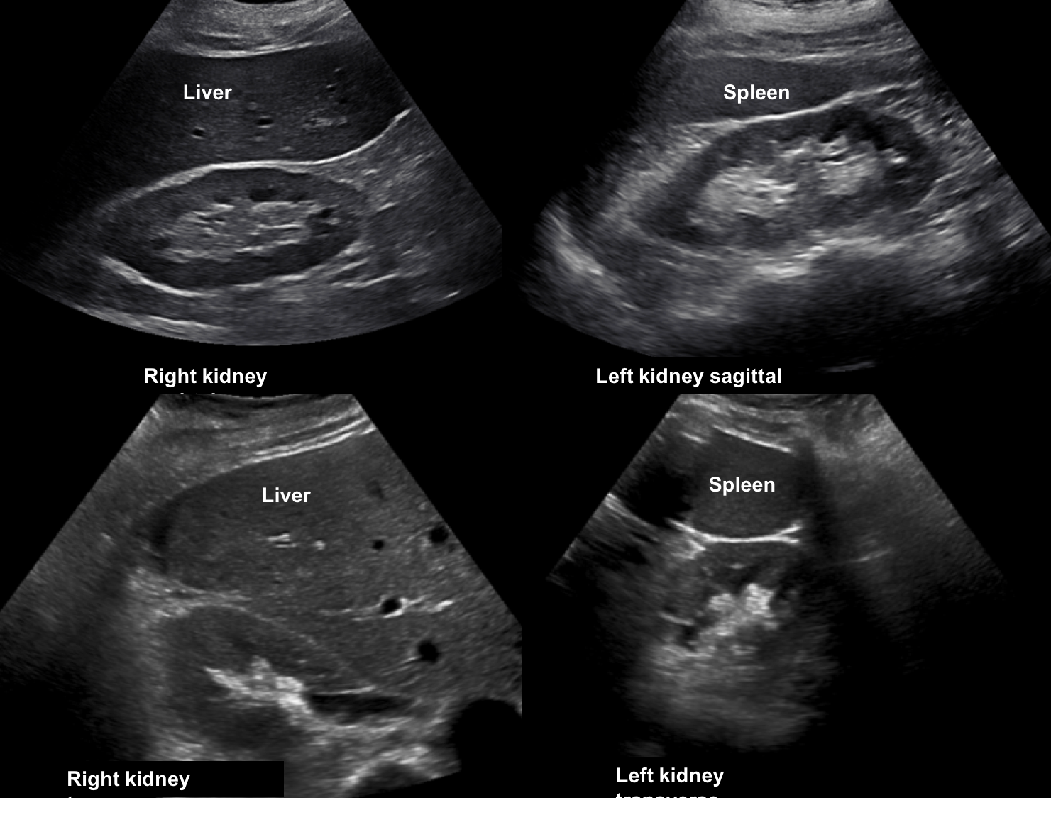 Normal Kidney Ultrasound Normal Kidney Ultrasound