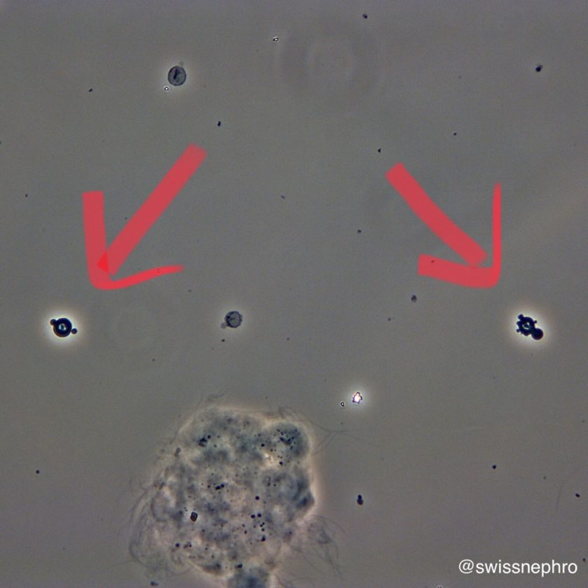Urine Sediment of the Month Dysmorphic RBCs, the Hallmark of Glomerular Hematuria Renal