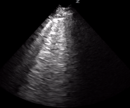 ultrasound Archives - Renal Fellow Network