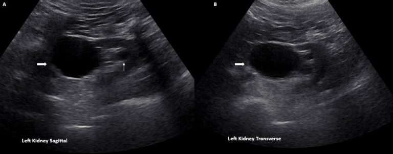 The Ultrasound Mimics Of Hydronephrosis Renal Fellow Network