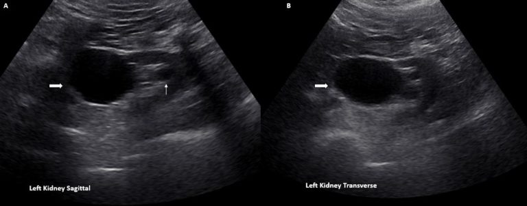 the-ultrasound-mimics-of-hydronephrosis-renal-fellow-network