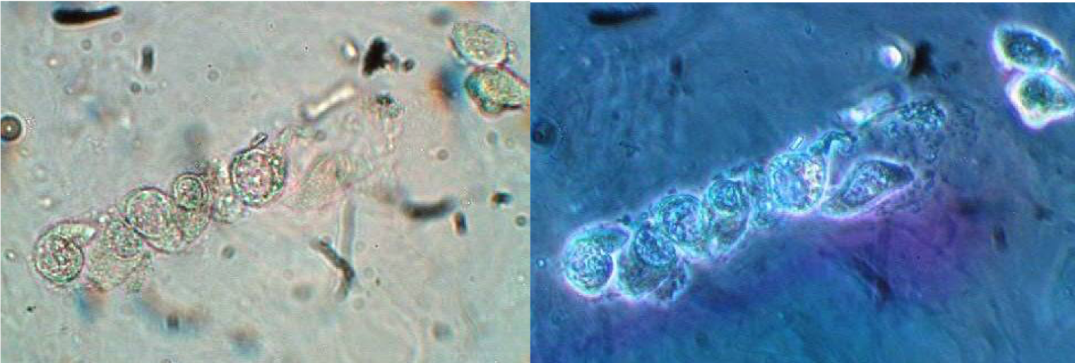 Urine Sediment of the Month Don't be Fooled by Decoy Cells...A Clue to