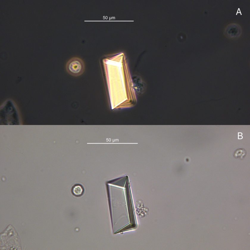 Urine Sediment of the Month Common Crystals! Renal Fellow Network