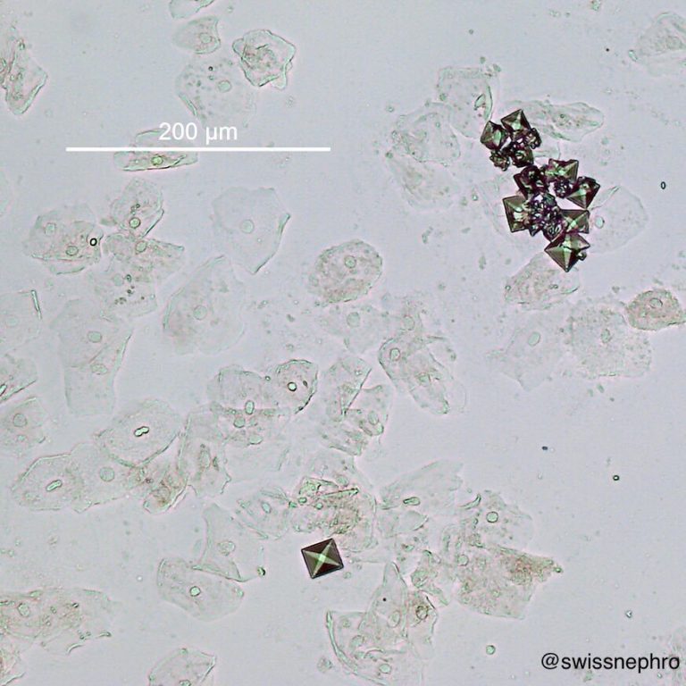 Urine Sediment of the Month Common Crystals! Renal Fellow Network