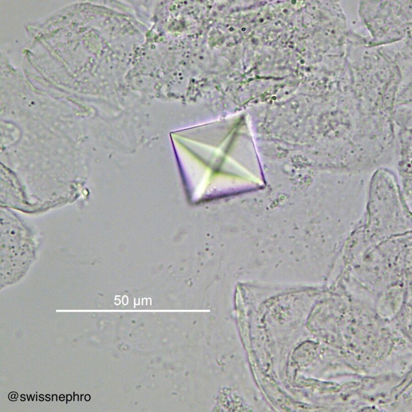 Urine Sediment of the Month Common Crystals! Renal Fellow Network