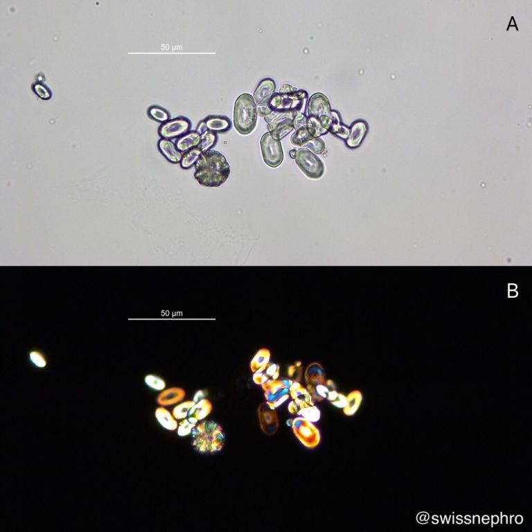 Urine Sediment of the Month Common Crystals! Renal Fellow Network