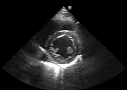 Focused Cardiac Ultrasound For The Nephrologist The Parasternal Short 