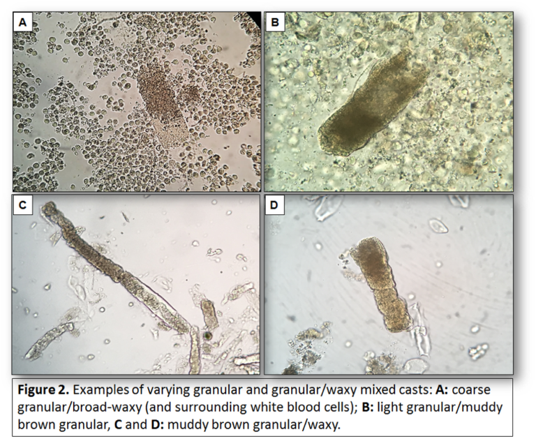 Urine Sediment of the Month Mixed, Acellular Casts Renal Fellow Network