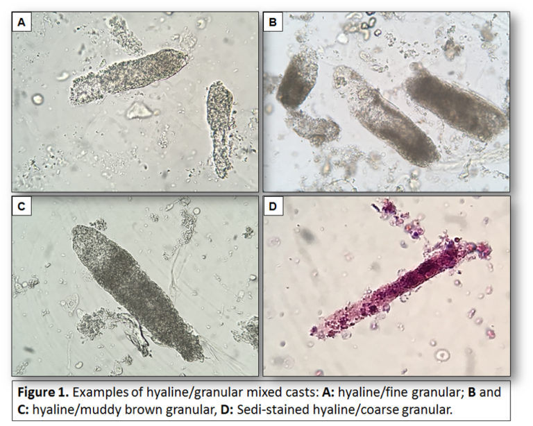 Urine Sediment of the Month Mixed, Acellular Casts Renal Fellow Network