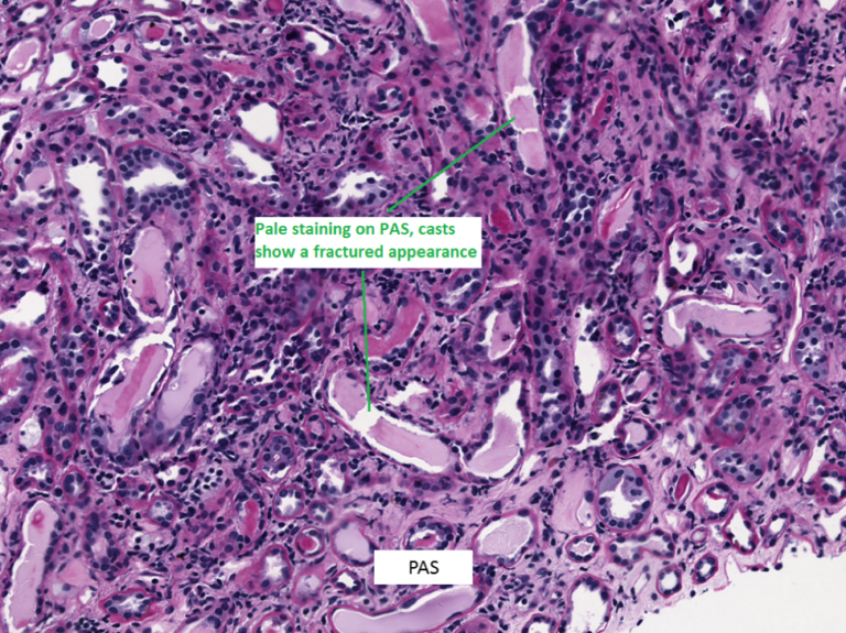 Kidney Biopsy of the Month Light Chain Cast Nephropathy Renal Fellow Network