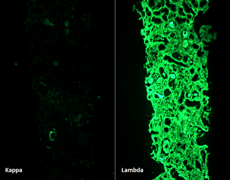 Kidney Biopsy of the Month Light Chain Cast Nephropathy Renal Fellow