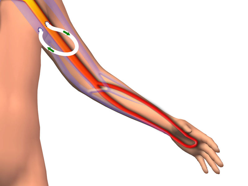 Troubleshooting Two Vascular Access Cases Early Cannulation Graft and