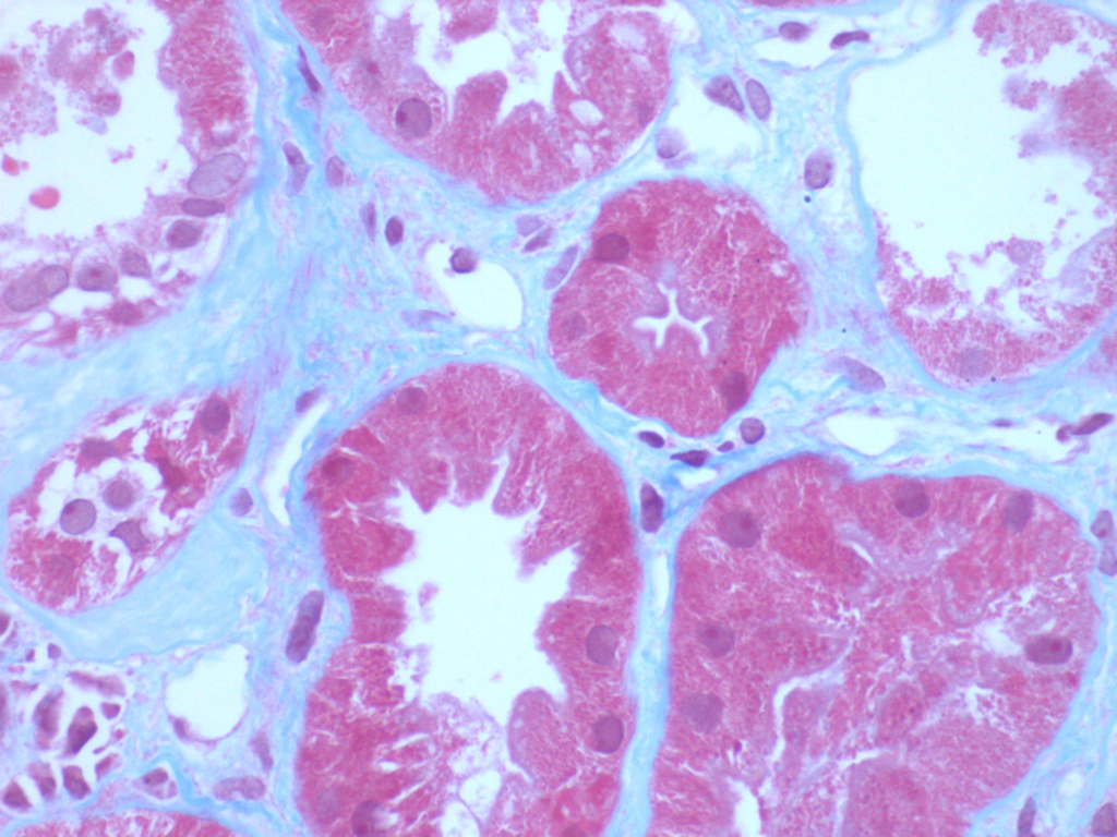 Kidney Biopsy of the Month Light Chain Proximal Tubulopathy with Crystals (LCPT) Renal Fellow