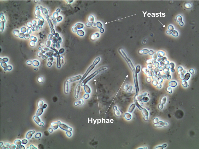 Urine Sediment of the Month: Microorganisms - Renal Fellow Network