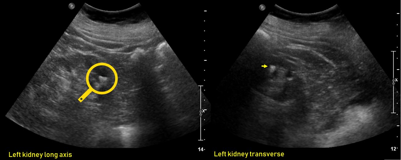 Ultrasound features of Kidney Cysts Renal Fellow Network