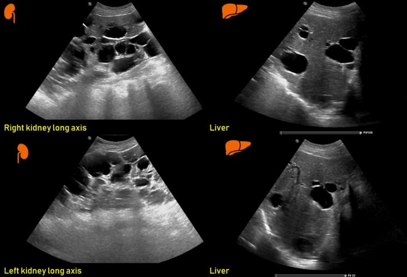 Ultrasound features of Kidney Cysts Renal Fellow Network