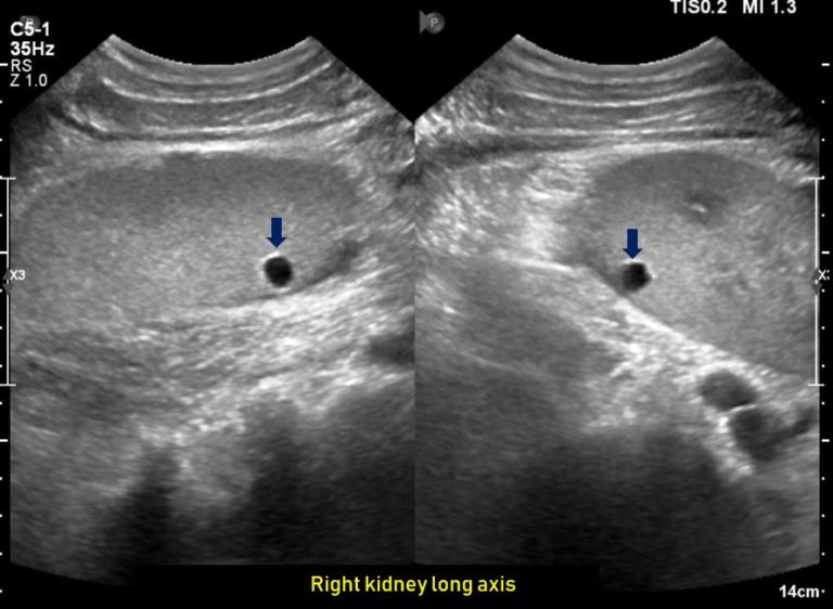 Ultrasound features of Kidney Cysts Renal Fellow Network