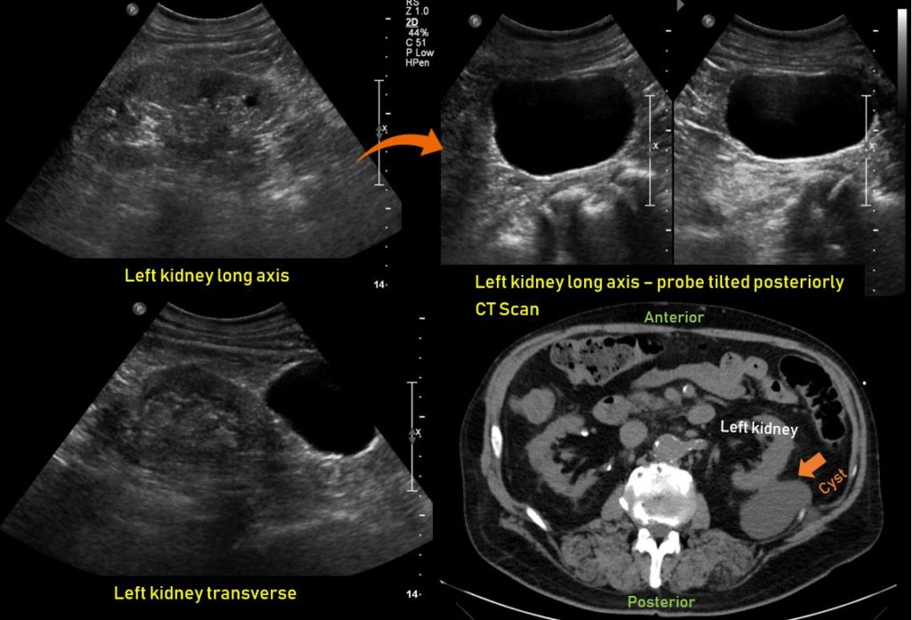 Kidney Ultrasound Cyst