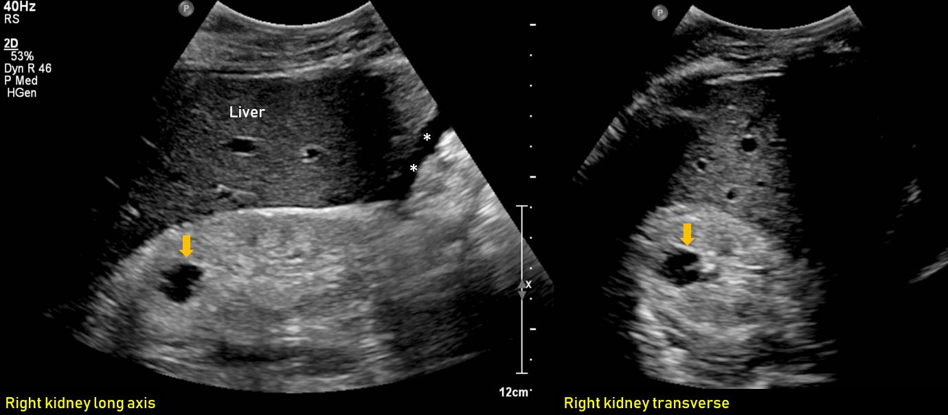 Ultrasound features of Kidney Cysts Renal Fellow Network