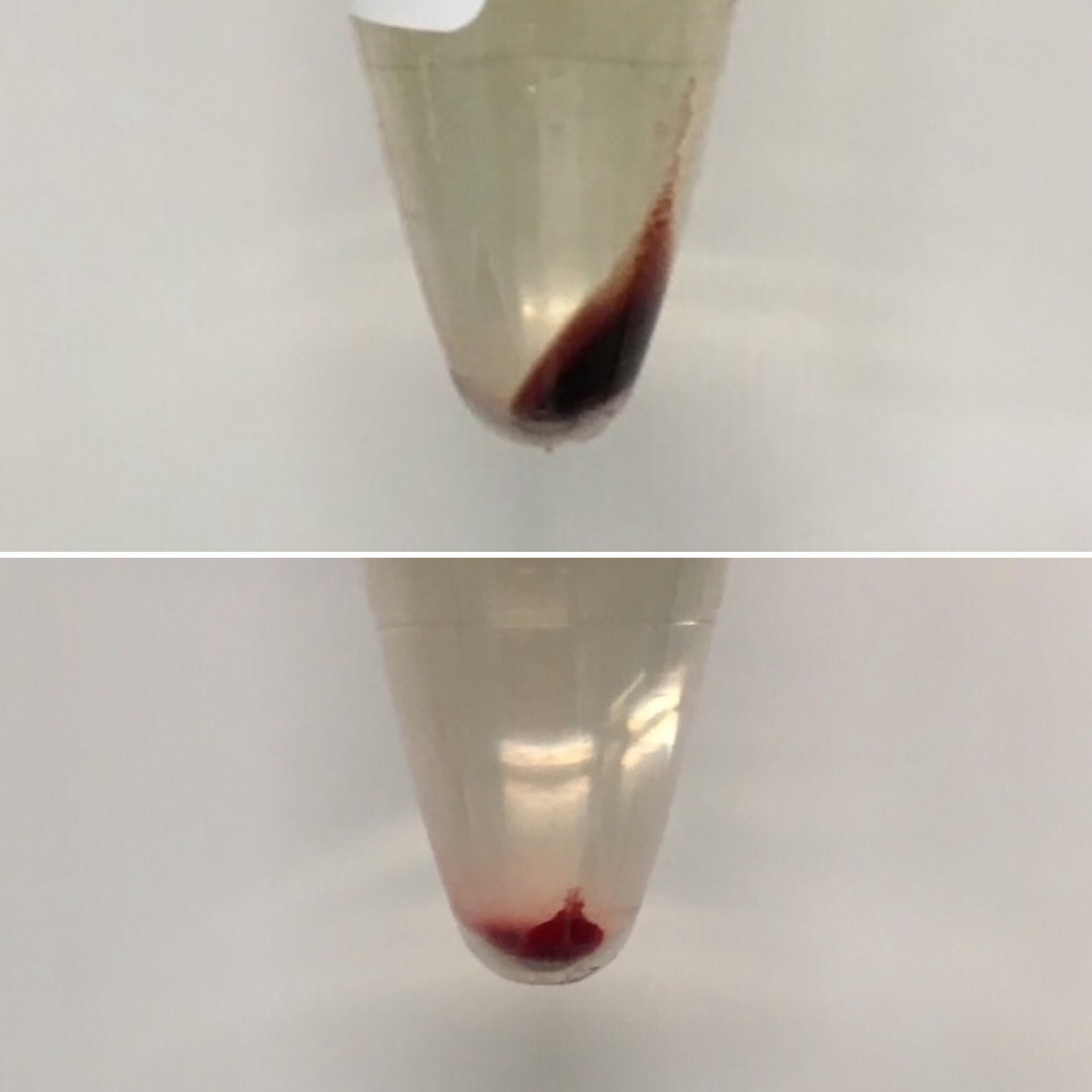 Urine Sediment of the Month The Visible Sediment Renal Fellow Network