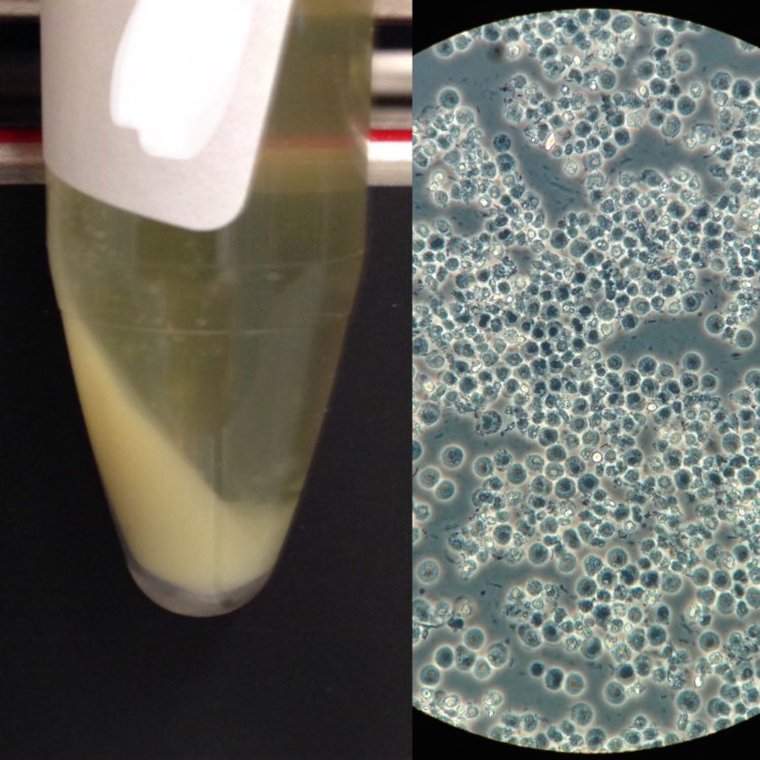 Urine Sediment of the Month The Visible Sediment Renal Fellow Network