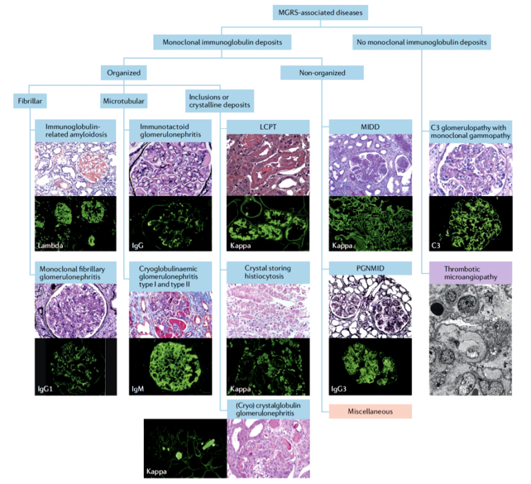Kidney Biopsy of the Month Glomerular diseases with organized deposits