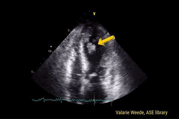 Focused Cardiac Ultrasound: Abnormalities on the Apical View - Renal Fellow Network