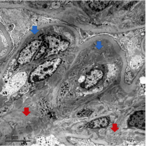 Kidney Biopsy of the Month: C3 Glomerulonephritis - Renal Fellow Network
