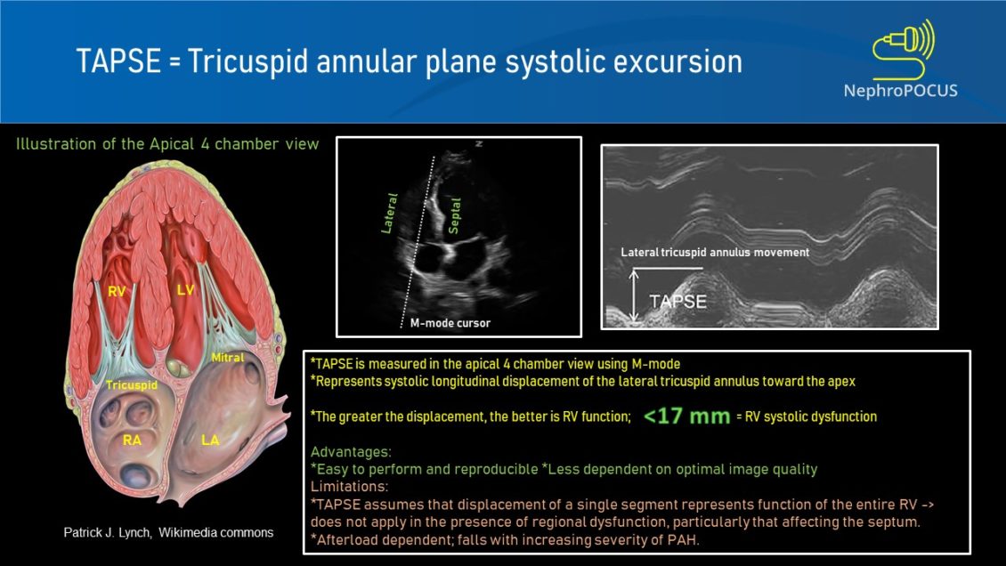 Focused Cardiac Ultrasound for the Nephrologist Utility of the Mmode