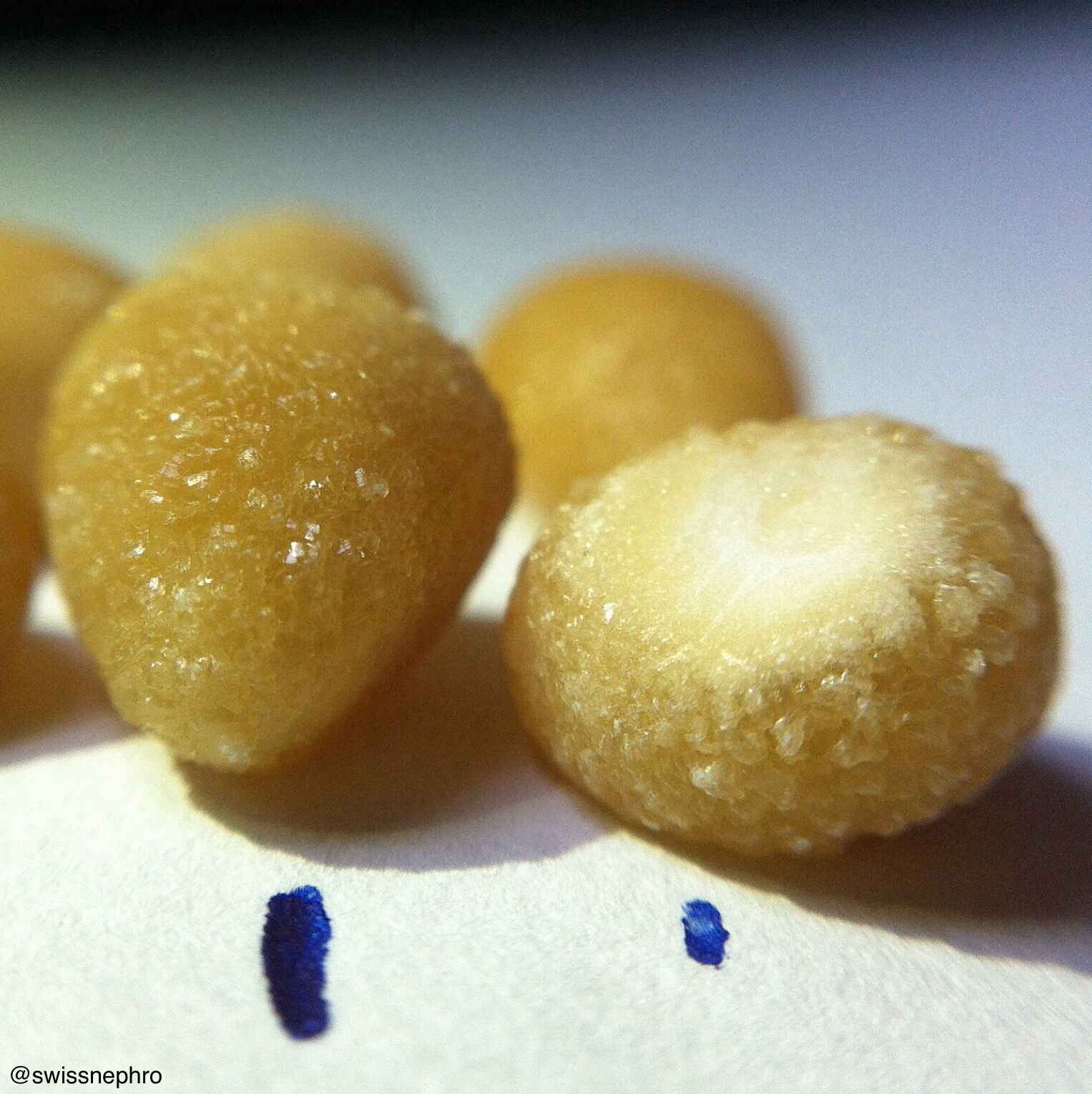 Urine Sediment of the Month Cystine Crystals Renal Fellow Network