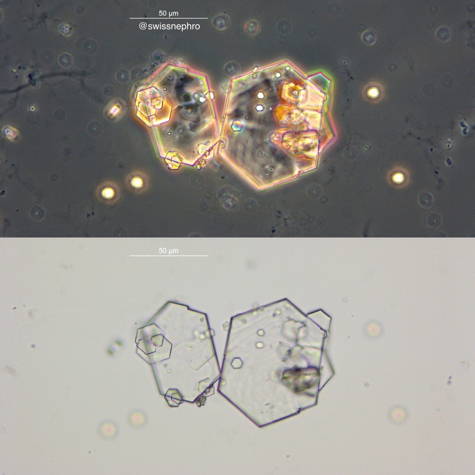 Urine Sediment of the Month Cystine Crystals Renal Fellow Network