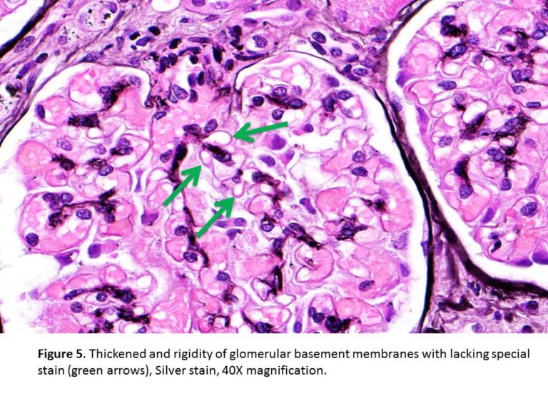 Kidney Biopsy of the Month Membranous Nephropathy Renal Fellow Network