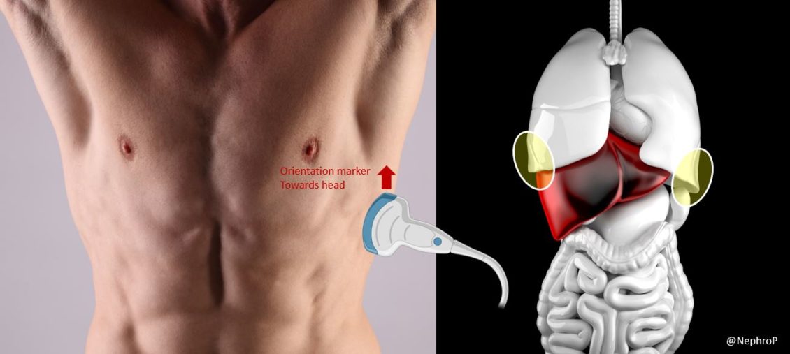An Overview of Lung Ultrasound for the Nephrologist The COVID edition