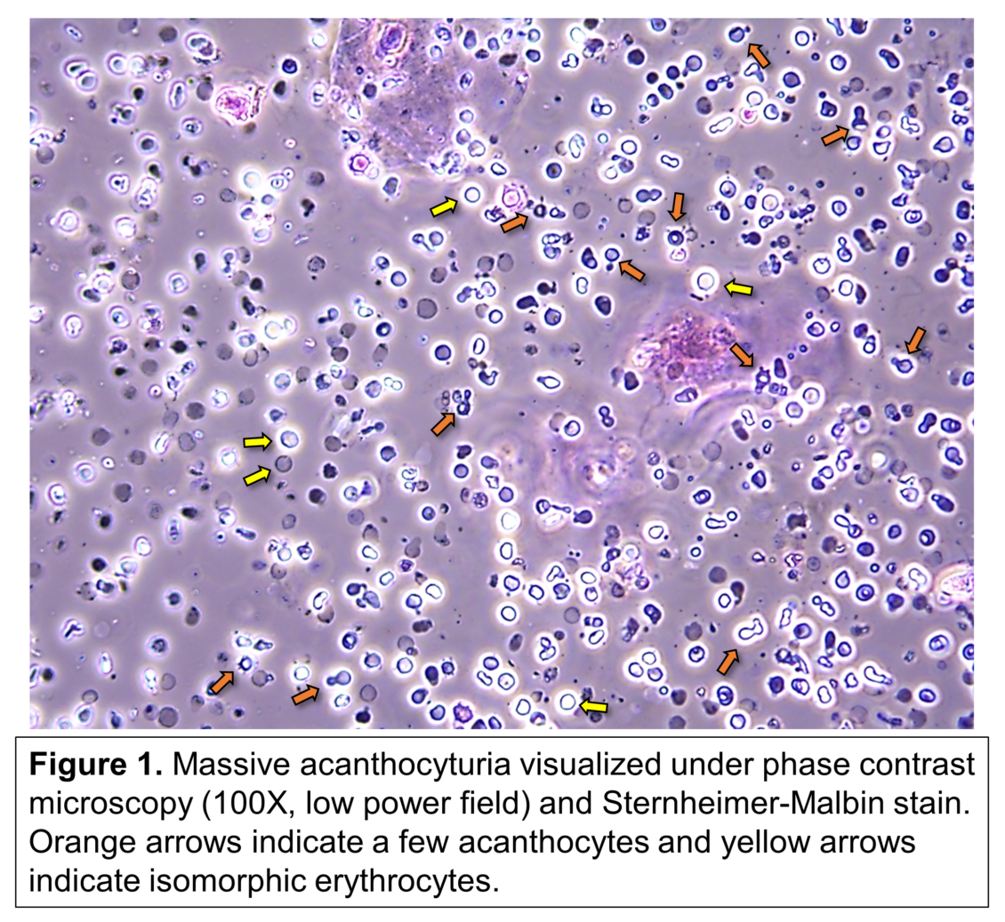 Cells In Urine Sediment Chart Urine Sediment Of The Month Fat Oval