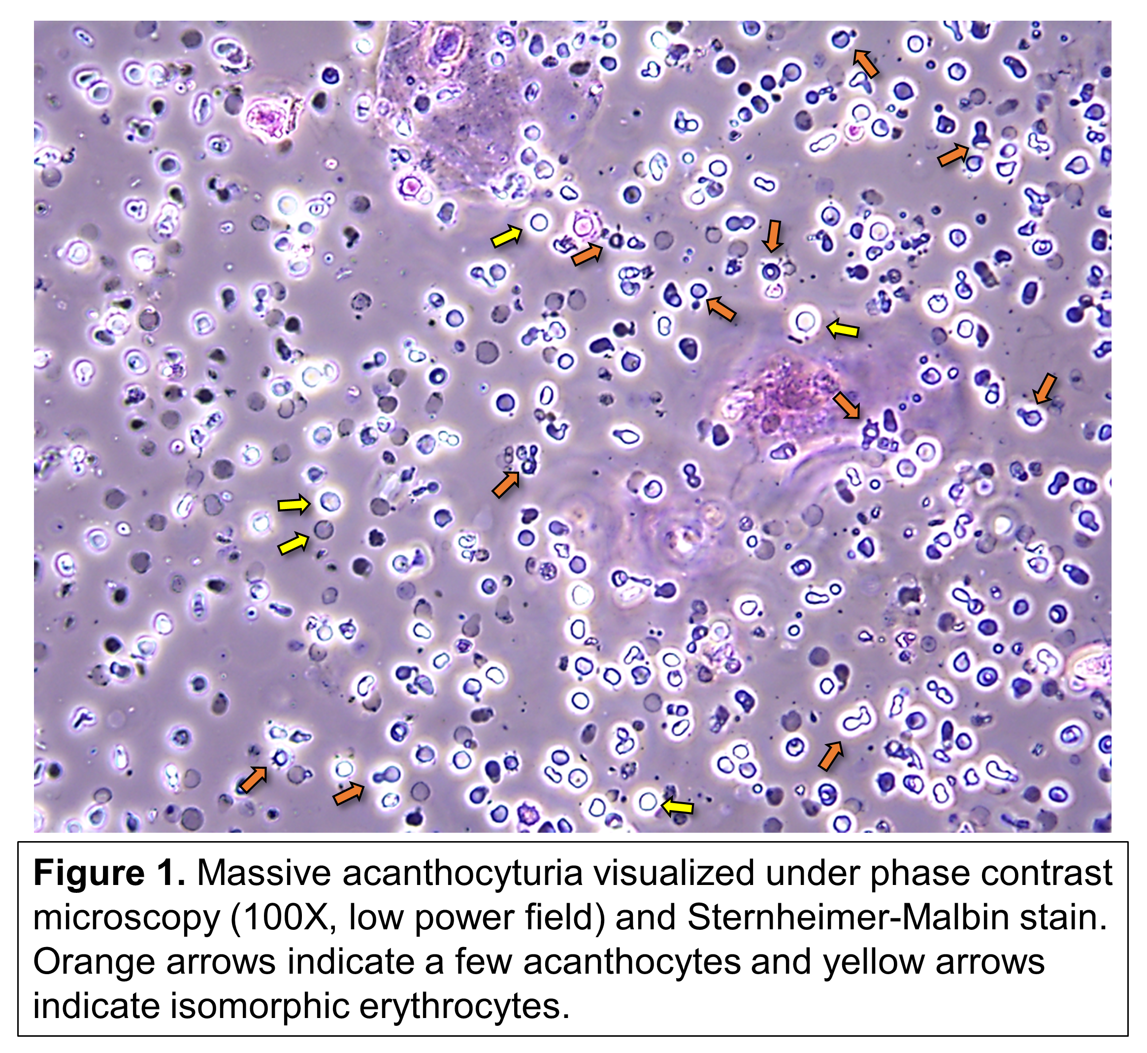 Urine Sediment of the Month: Dysmorphic Cells, Blebs, & Spikes - Renal Fellow Network