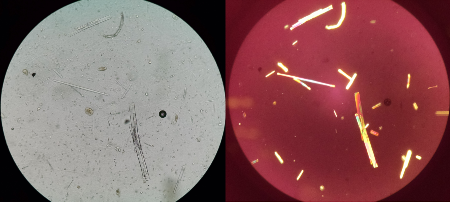 Urine Sediment of the Month Drugs & Crystalluria Renal Fellow Network