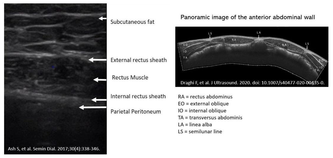 Bedside Ultrasonography of the Peritoneal Dialysis Catheter Renal