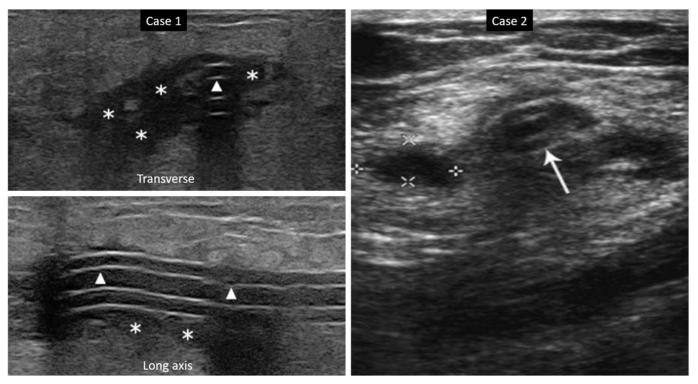 Bedside Ultrasonography of the Peritoneal Dialysis Catheter Renal