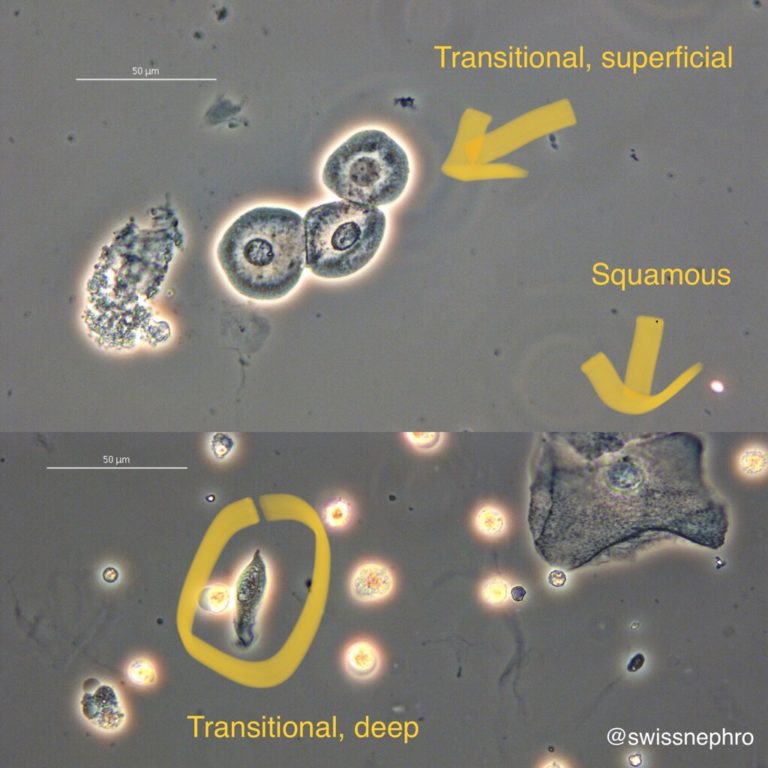 Urine Sediment of the Month 4 Flavors of Nucleated Cells Renal