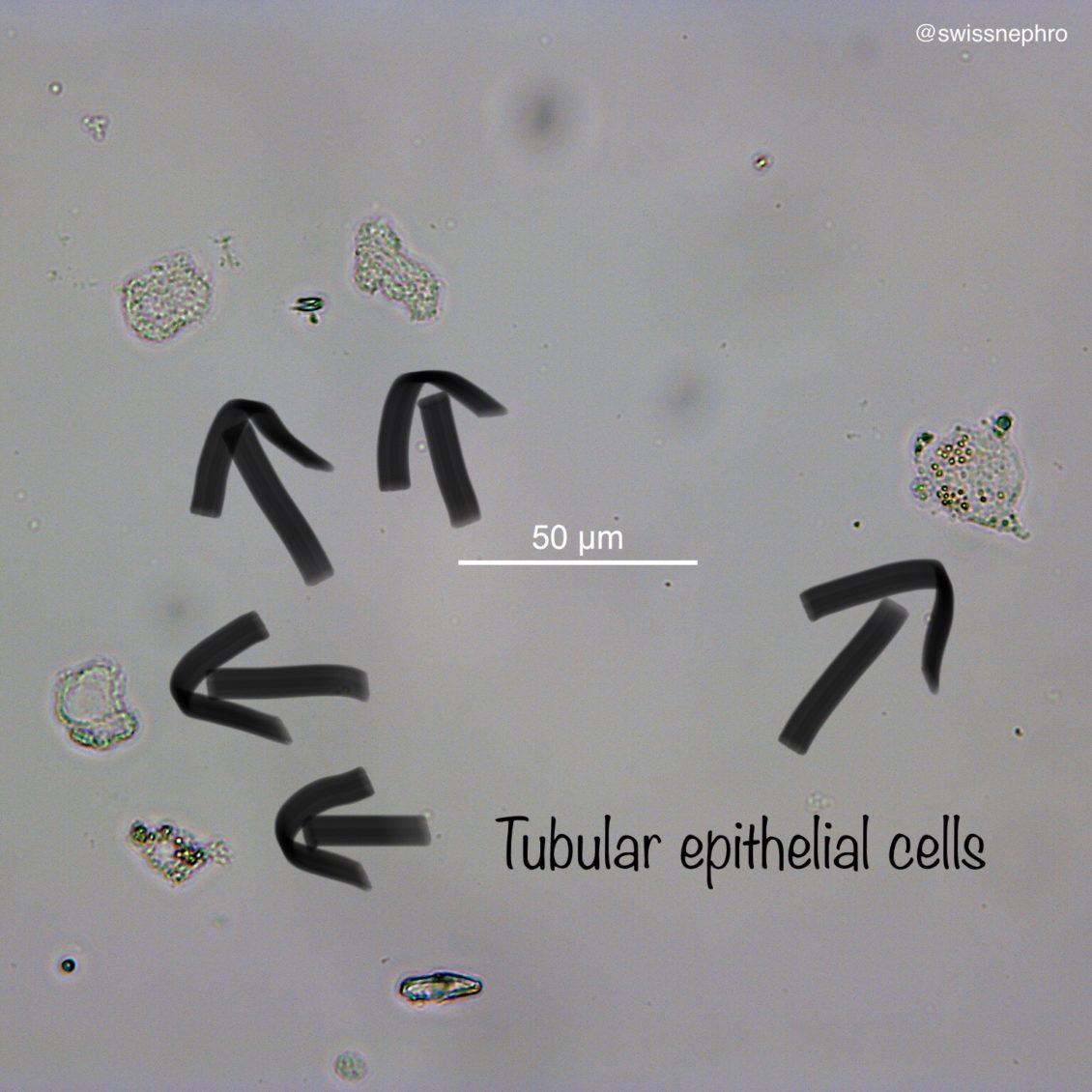 Urine Sediment of the Month 4 Flavors of Nucleated Cells Renal