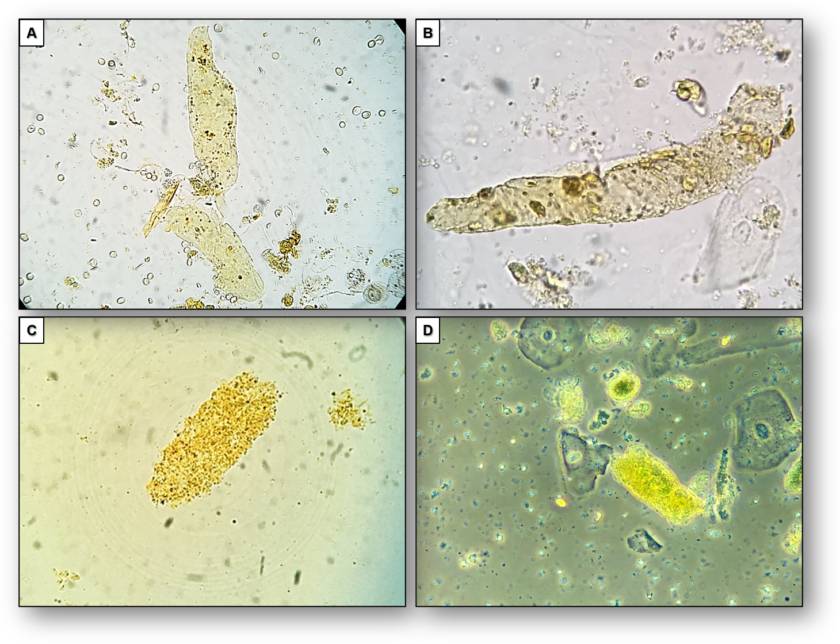 Urine Sediment of the Month Findings in Cirrhosis, Cholestasis, and