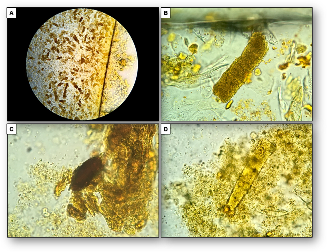 Urine Sediment of the Month Findings in Cirrhosis, Cholestasis, and